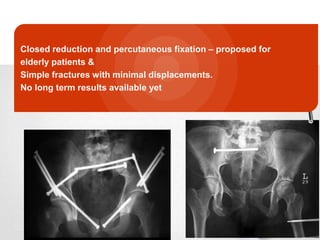 Closed reduction and percutaneous fixation – proposed for
elderly patients &
Simple fractures with minimal displacements.
No long term results available yet

 