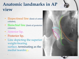 Anatomic landmarks in AP
view
• Iliopectineal line (limit of anterior
column),

• Ilioischial line (limit of posterior
column),

• Anterior lip,
• Posterior lip,
• Line depicting the superior
weight-bearing
surface, terminating as the
medial teardrop.

 