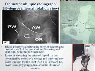 Obturator oblique radiograph
(45-degree internal rotation view)

• This is best for evaluating the anterior column and
posterior wall of the acetabulum(iliac wing and
spur sign(both colum # seen here)
• Taken by elevating the affected hip 45 to the
horizontal by means of a wedge and directing the
beam through the hip joint with a 15 upward tilt.
beam is roughly perpendicular to the obturator
foramen

 