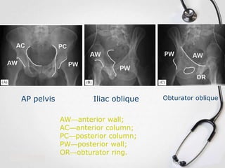 AP pelvis

Iliac oblique
AW—anterior wall;
AC—anterior column;
PC—posterior column;
PW—posterior wall;
OR—obturator ring.

Obturator oblique

 
