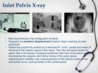 Inlet Pelvis X-ray

• Best demonstrates ring configuration of pelvis
• Evaluates for posterior displacement of pelvic ring or opening of pubic
symphysis
• Patient lies supineThe central ray is directed 40 to 60 caudal and enters at
the level of the anterior superior iliac spine. This view will demonstrate the
pelvic inlet in its entirety. A properly positioned inlet view of the pelvis should
demonstrate the superior and inferior ramus of the pubic bones
superimposed medially, near superimposition of the superior pubic ramus
and ischial ramus, and symmetry of the ischial spines

 