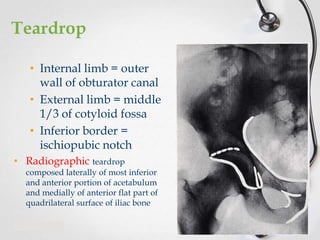 Teardrop
• Internal limb = outer
wall of obturator canal
• External limb = middle
1/3 of cotyloid fossa
• Inferior border =
ischiopubic notch
• Radiographic teardrop

composed laterally of most inferior
and anterior portion of acetabulum
and medially of anterior flat part of
quadrilateral surface of iliac bone

 