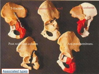 T-fracture

Transverse/post.wall

Post.wall/post.column

Associated types

Ass.both.column

Ant.post.hemitrans.

Othopaedic Review Course
January 2010

 