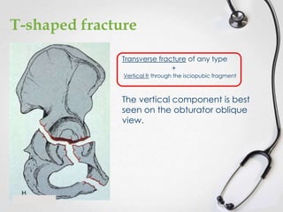 T-shaped fracture
Transverse fracture of any type
+
Vertical fr through the isciopubic fragment

The vertical component is best
seen on the obturator oblique
view.

 