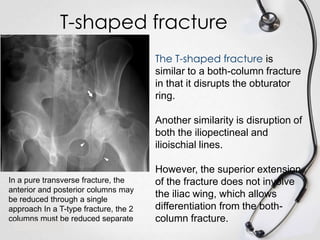 T-shaped fracture
The T-shaped fracture is
similar to a both-column fracture
in that it disrupts the obturator
ring.
Another similarity is disruption of
both the iliopectineal and
ilioischial lines.

In a pure transverse fracture, the
anterior and posterior columns may
be reduced through a single
approach In a T-type fracture, the 2
columns must be reduced separate

However, the superior extension
of the fracture does not involve
the iliac wing, which allows
differentiation from the bothcolumn fracture.

 