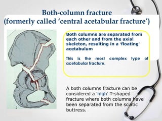 Both-column fracture
(formerly called ‘central acetabular fracture’)
Both columns are separated from
each other and from the axial
skeleton, resulting in a ‘floating’
acetabulum
This is the most complex
acetabular fracture.

type

A both columns fracture can be
considered a ‘high’ T-shaped
fracture where both columns have
been separated from the sciatic
buttress.

of

 