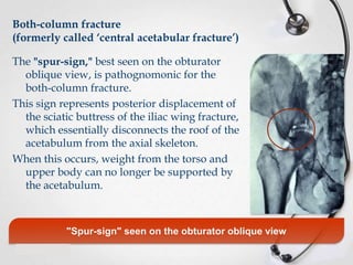 Both-column fracture
(formerly called ‘central acetabular fracture’)
The "spur-sign," best seen on the obturator
oblique view, is pathognomonic for the
both-column fracture.
This sign represents posterior displacement of
the sciatic buttress of the iliac wing fracture,
which essentially disconnects the roof of the
acetabulum from the axial skeleton.
When this occurs, weight from the torso and
upper body can no longer be supported by
the acetabulum.

"Spur-sign" seen on the obturator oblique view

 