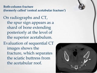 Both-column fracture
(formerly called ‘central acetabular fracture’)

On radiographs and CT,
the spur sign appears as a
shard of bone extending
posteriorly at the level of
the superior acetabulum.
Evaluation of sequential CT
images shows the
fracture, which separates
the sciatic buttress from
the acetabular roof.

 