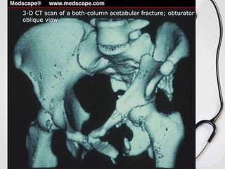 3-D CT scan of a both-column acetabular fracture; obturator
oblique view

 
