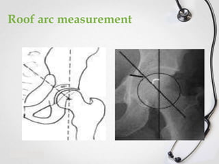 Roof arc measurement

 