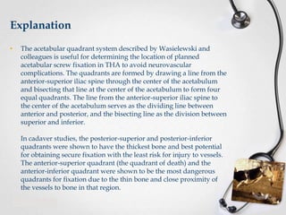 Explanation
•

The acetabular quadrant system described by Wasielewski and
colleagues is useful for determining the location of planned
acetabular screw fixation in THA to avoid neurovascular
complications. The quadrants are formed by drawing a line from the
anterior-superior iliac spine through the center of the acetabulum
and bisecting that line at the center of the acetabulum to form four
equal quadrants. The line from the anterior-superior iliac spine to
the center of the acetabulum serves as the dividing line between
anterior and posterior, and the bisecting line as the division between
superior and inferior.
In cadaver studies, the posterior-superior and posterior-inferior
quadrants were shown to have the thickest bone and best potential
for obtaining secure fixation with the least risk for injury to vessels.
The anterior-superior quadrant (the quadrant of death) and the
anterior-inferior quadrant were shown to be the most dangerous
quadrants for fixation due to the thin bone and close proximity of
the vessels to bone in that region.

 