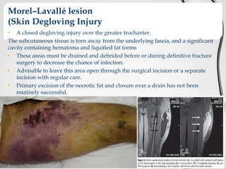 Morel–Lavallé lesion
(Skin Degloving Injury
• A closed degloving injury over the greater trochanter.
The subcutaneous tissue is torn away from the underlying fascia, and a significant
cavity containing hematoma and liquified fat forms
• These areas must be drained and debrided before or during definitive fracture
surgery to decrease the chance of infection.
• Advisable to leave this area open through the surgical incision or a separate
incision with regular care.
• Primary excision of the necrotic fat and closure over a drain has not been
routinely successful.

 