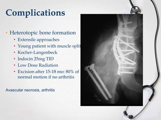 Complications
• Heterotopic bone formation
•
•
•
•
•
•

Extensile approaches
Young patient with muscle split
Kocher-Langenbeck
Indocin 25mg TID
Low Dose Radiation
Excision after 15-18 mo: 80% of
normal motion if no arthritis

Avascular necrosis, arthritis

 