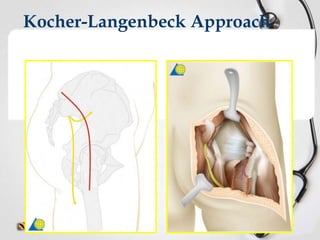 Kocher-Langenbeck Approach

 