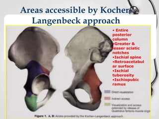 Areas accessible by KocherLangenbeck approach
• Entire
posterior
column
•Greater &
lesser sciatic
notches
•Ischial spine
•Retroacetabul
ar surface
•Ischial
tuberosity
•Ischiopubic
ramus

 