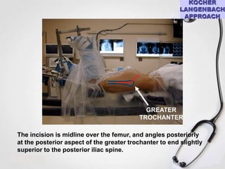 GREATER
TROCHANTER

The incision is midline over the femur, and angles posteriorly
at the posterior aspect of the greater trochanter to end slightly
superior to the posterior iliac spine.

 