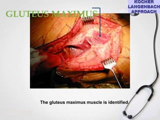 GLUTEUS MAXIMUS

The gluteus maximus muscle is identified.

 