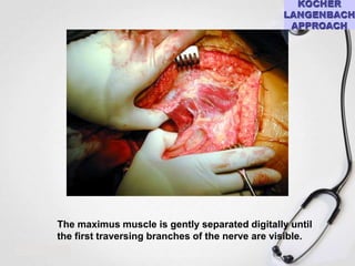 The maximus muscle is gently separated digitally until
the first traversing branches of the nerve are visible.

 