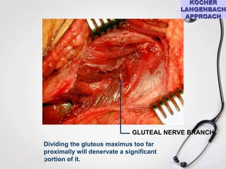 GLUTEAL NERVE BRANCH
Dividing the gluteus maximus too far
proximally will denervate a significant
portion of it.

 
