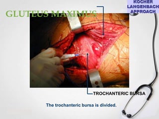 GLUTEUS MAXIMUS

TROCHANTERIC BURSA
The trochanteric bursa is divided.

 