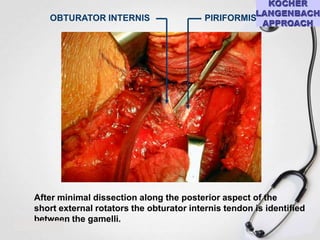 OBTURATOR INTERNIS

PIRIFORMIS

After minimal dissection along the posterior aspect of the
short external rotators the obturator internis tendon is identified
between the gamelli.

 