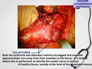 TAG SUTURES
Both the piriformis and obturator internis are tagged and resected
approximately 1cm away from their insertion in the femur. It is helpful
before this is performed, to identify the sciatic nerve in an area
of healthy tissue, usually at the level of the quadratus femoru

 