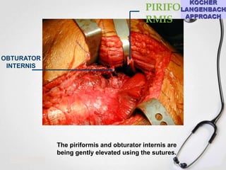 PIRIFO
RMIS

OBTURATOR
INTERNIS

The piriformis and obturator internis are
being gently elevated using the sutures.

 