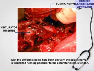 SCIATIC NERVE

OBTURATOR
INTERNIS

With the piriformis being held back digitally, the sciatic nerve
is visualized running posterior to the obturator internis tendon.

 