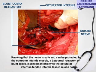 BLUNT COBRA
RETRACTOR

OBTURATOR INTERNIS

SCIATIC
NERVE

Knowing that the nerve is safe and can be protected by
the obturator internis muscle, a Letournel retractor, or
blunt cobra, is placed anteriorly to the obturator
internus tendon into the lesser sciatic notch.

 