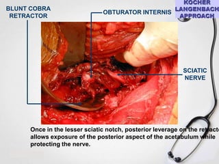 BLUNT COBRA
RETRACTOR

OBTURATOR INTERNIS

SCIATIC
NERVE

Once in the lesser sciatic notch, posterior leverage on the retracto
allows exposure of the posterior aspect of the acetabulum while
protecting the nerve.

 