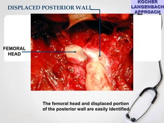 DISPLACED POSTERIOR WALL

FEMORAL
HEAD

The femoral head and displaced portion
of the posterior wall are easily identified.

 