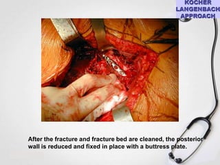 After the fracture and fracture bed are cleaned, the posterior
wall is reduced and fixed in place with a buttress plate.

 