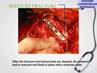 REDUCED FRACTURE

After the fracture and fracture bed are cleaned, the posterior
wall is reduced and fixed in place with a buttress plate.

 