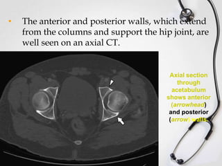 •

The anterior and posterior walls, which extend
from the columns and support the hip joint, are
well seen on an axial CT.

Axial section
through
acetabulum
shows anterior
(arrowhead)
and posterior
(arrow) walls.

 