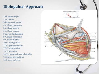 Ilioinguinal Approach
1 M. psoas major
2 M. iliacus
3 Pecten ossis pubis
4 A. iliaca communis
5 A. iliaca interna
6 A. iliaca externa
7 Aa. Vv. Testiculares
8 V. iliaca communis
9 V. iliaca externa
10 N. ilioinguinalis
11 N. genitofemoralis
12 N. obturatorius
13 N. femoralis
14 N. cutaneus femoris lateralis
15 Ductus spermaticus
16 Ductus deferens

 
