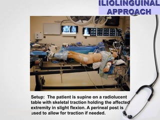 Setup: The patient is supine on a radiolucent
table with skeletal traction holding the affected
extremity in slight flexion. A perineal post is
used to allow for traction if needed.

 