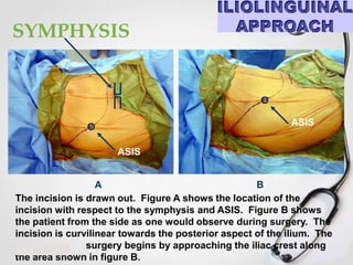 SYMPHYSIS

ASIS
ASIS
A
B
The incision is drawn out. Figure A shows the location of the
incision with respect to the symphysis and ASIS. Figure B shows
the patient from the side as one would observe during surgery. The
incision is curvilinear towards the posterior aspect of the ilium. The
surgery begins by approaching the iliac crest along
the area shown in figure B.

 
