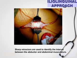 Sharp retractors are used to identify the interval
between the abductor and abdominal musculature.

 