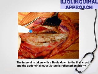 The interval is taken with a Bovie down to the iliac crest
and the abdominal musculature is reflected anteriorly.

 
