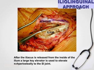 ILIACUS

ILIUM

After the iliacus is released from the inside of the
ilium a large key elevator is used to elevate
subperiosteally to the SI joint.

 