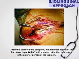 After this dissection is complete, the posterior aspect of the
iliac fossa is packed off with a lap and attention to brought
to the anterior portion of the incision.

 