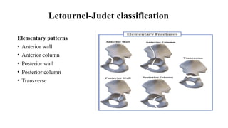 Jude Letournel Classification acetabulum final ppt in pelvis after traumatic experience | PPTX