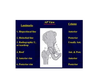 Acetabulum Fracture