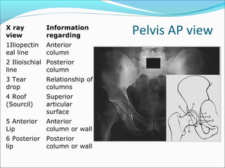 Pelvis AP viewX ray
view
Information
regarding
1Iliopectin
eal line
Anterior
column
2 Ilioischial
line
Posterior
column
3 Tear
drop
Relationship of
columns
4 Roof
(Sourcil)
Superior
articular
surface
5 Anterior
Lip
Anterior
column or wall
6 Posterior
lip
Posterior
column or wall
 