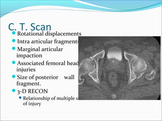 C. T. ScanRotational displacements
Intra articular fragments
Marginal articular
impaction
Associated femoral head
injuries
Size of posterior wall
fragment.
3-D RECON
Relationship of multiple sites
of injury
 