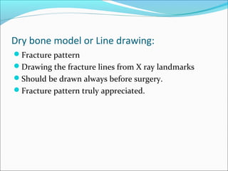 Dry bone model or Line drawing:
Fracture pattern
Drawing the fracture lines from X ray landmarks
Should be drawn always before surgery.
Fracture pattern truly appreciated.
 