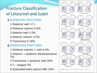 Fracture Classification
of Letournel and Judet
A ELIMENTARY FRACTURES
1 Posterior wall 30%
2 Posterior column 3-5%
3 Anterior wall 1-2%
4 Anterior column 3-5%
5 Transverse 5-19%
B ASSOCIATED FRACTURES
1 Posterior column + wall 3-4%
2 Anterior + posterior Hemitransverse
7%
3 Transverse + posterior wall 20%
4 T – shaped 7%
5 Associated both column ABC 23%
 