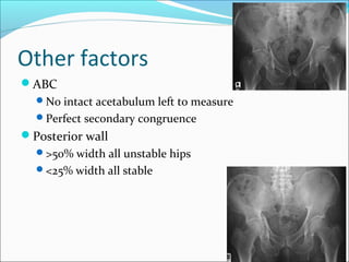 Other factors
ABC
No intact acetabulum left to measure
Perfect secondary congruence
Posterior wall
>50% width all unstable hips
<25% width all stable
 