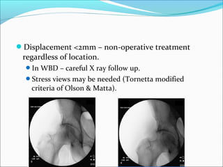 Displacement <2mm – non-operative treatment
regardless of location.
In WBD – careful X ray follow up.
Stress views may be needed (Tornetta modified
criteria of Olson & Matta).
 
