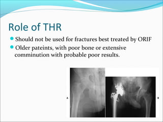 Role of THR
Should not be used for fractures best treated by ORIF
Older pateints, with poor bone or extensive
comminution with probable poor results.
 